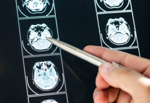 cannabinoids for traumatic brain injury